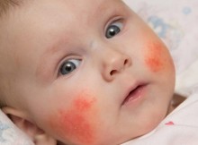 Kenali dan Atasi Dermatitis Atopik Pada Bayi